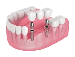 Dental-bridge-implant